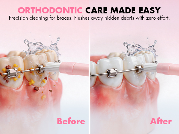 water flossers for braces