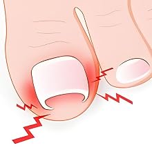 Nail care, ingrown nails, home treatment, podiatrist, effective, professional results