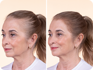 HLP - thinning hair