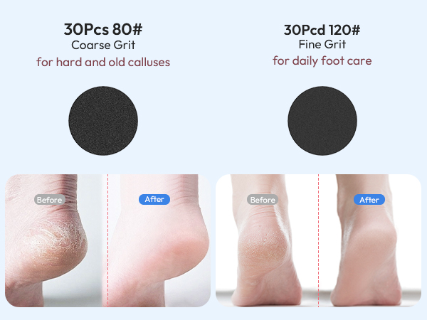 electric foot callus remover