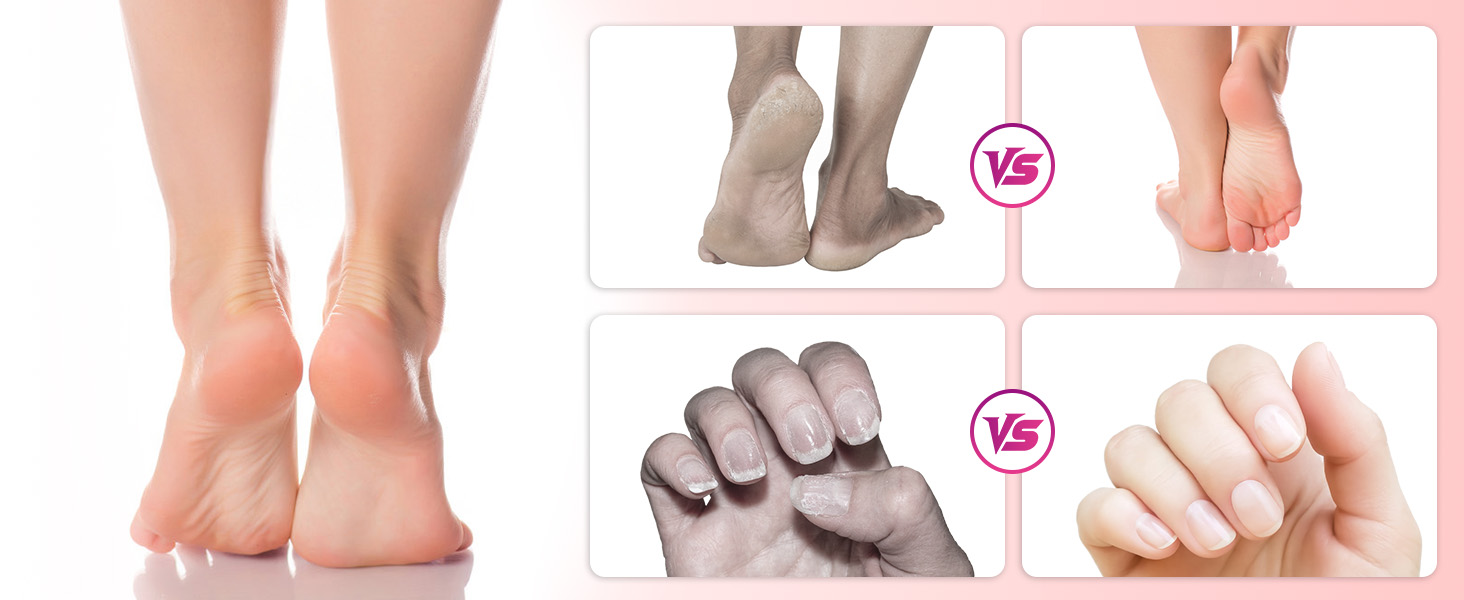 electric foot callus remover