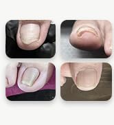 ingrown-toenail-removal-kit