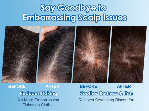 psoriasis shampoo