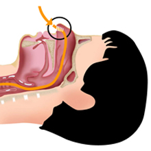 medical vents snore stopping