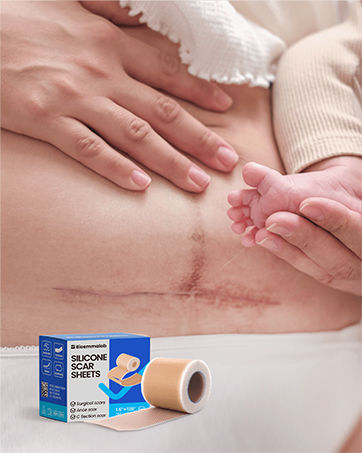 Silicone Scar Sheets