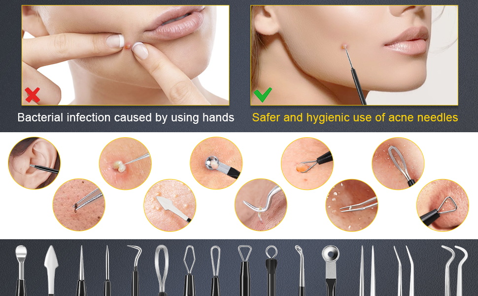 Do not squeeze pimples with your hands