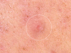 pimple patches