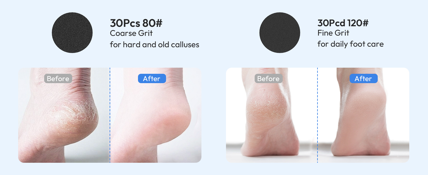 electric foot callus remover