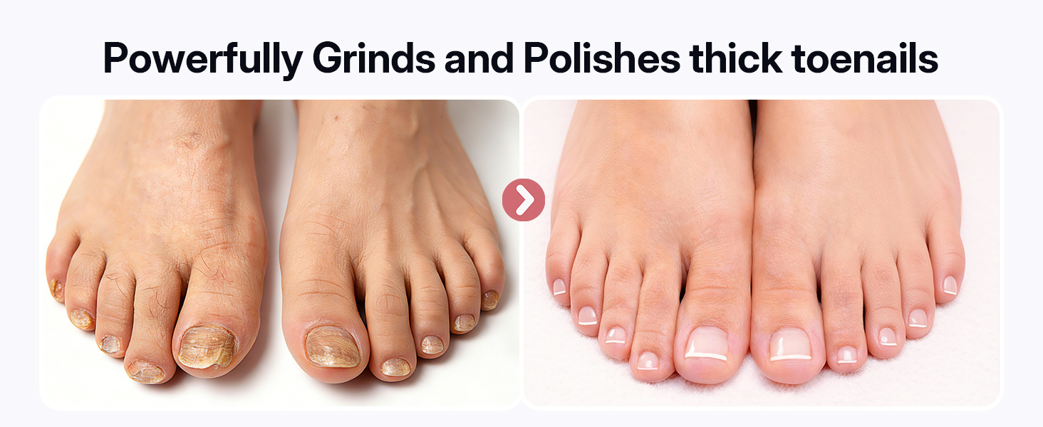 electric callus remover for feet