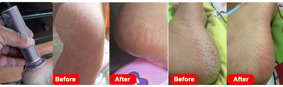 electric callus remover