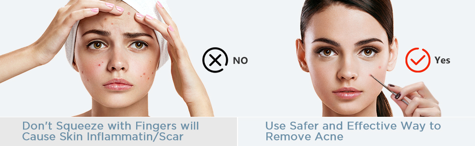 blackhead remover