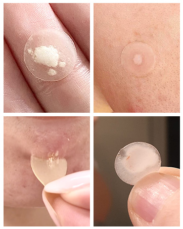 pimple patches