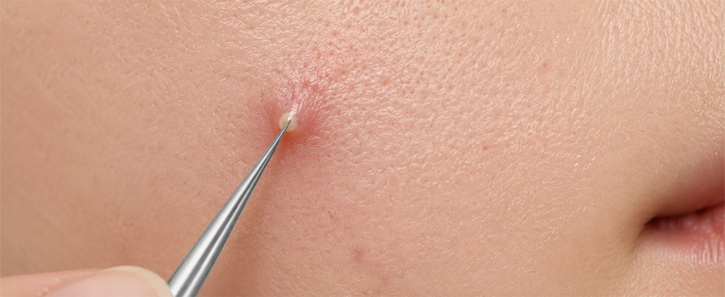 pimple popper tool