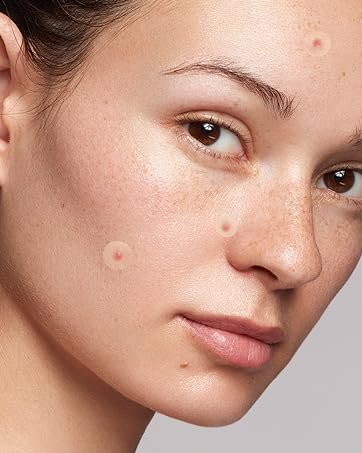pimple patches