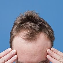 Hair Loss