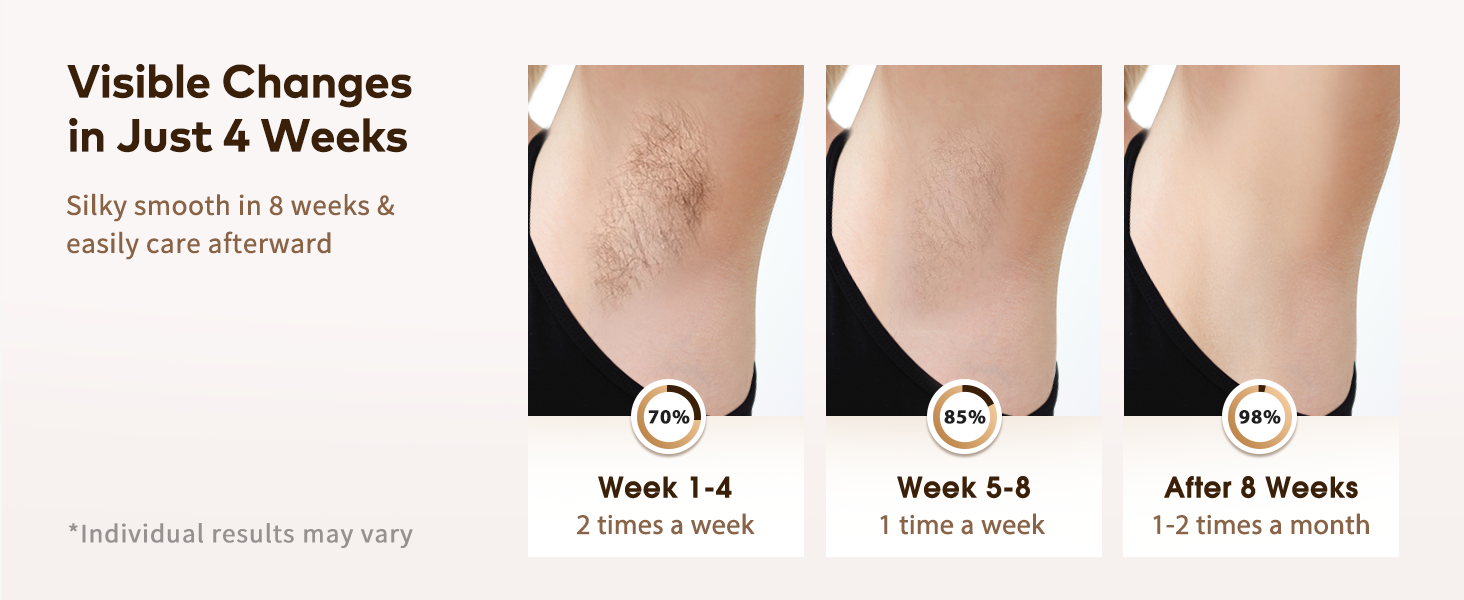 ipl hair removal