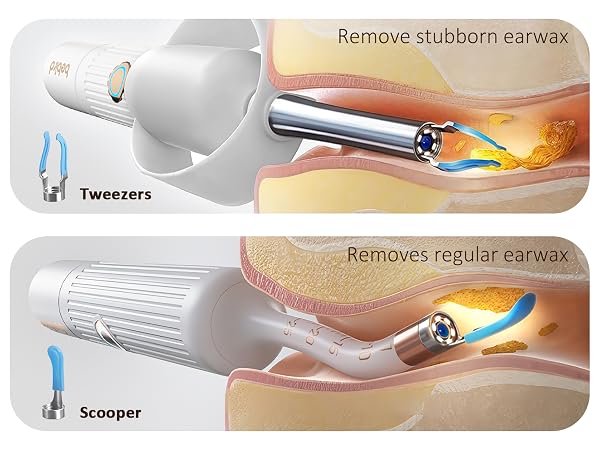 ear camera wax removal