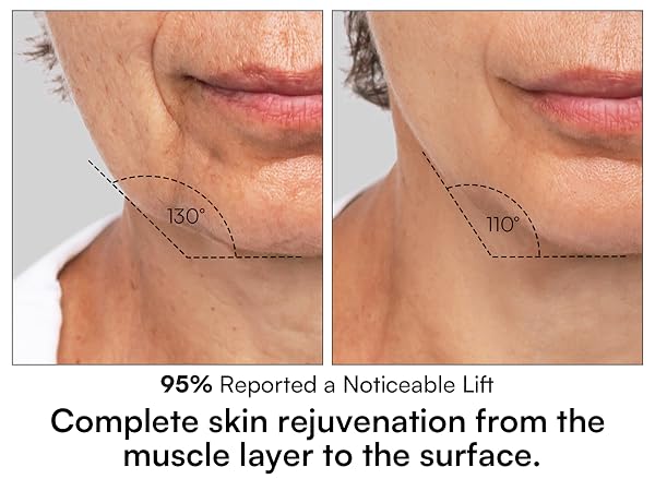 Red Light Therapy for Face