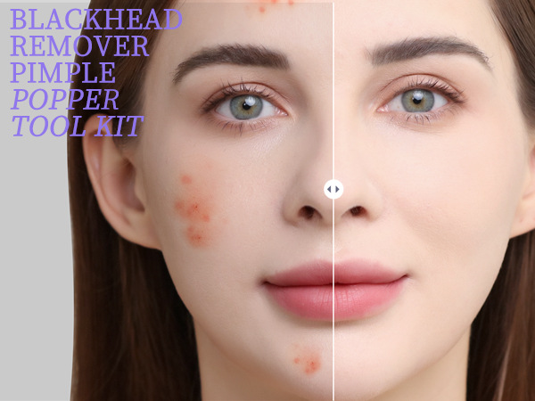 Blackhead Remover