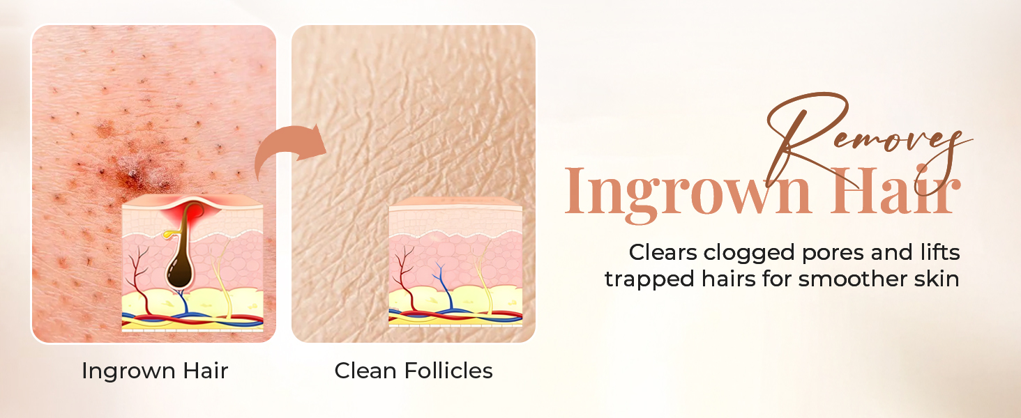 best to removes ingrown hair