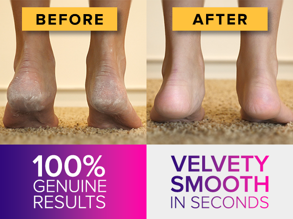 Before and after foot images promoting skin smoothing product. Shows dry, cracked heels transformed to smooth skin. Text claims '100% genuine results' and 'velvety smooth'.