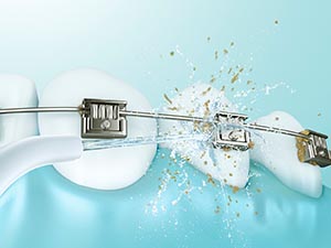 Works Around Braces