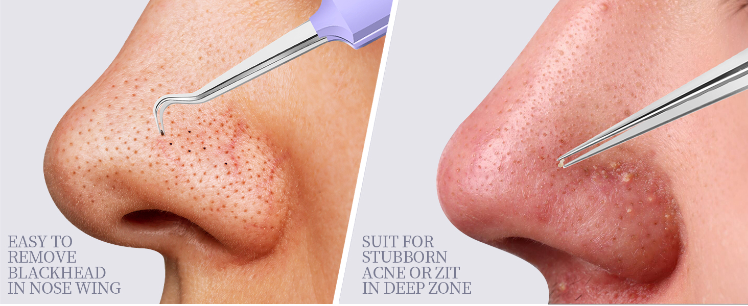 Pimple Extractor