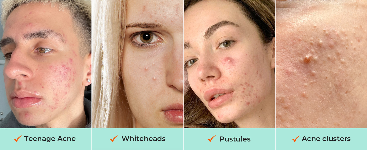 Suitable for Most Pimples