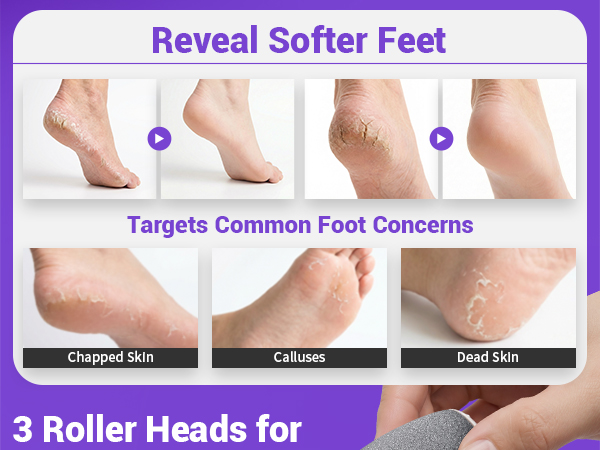 callus removers