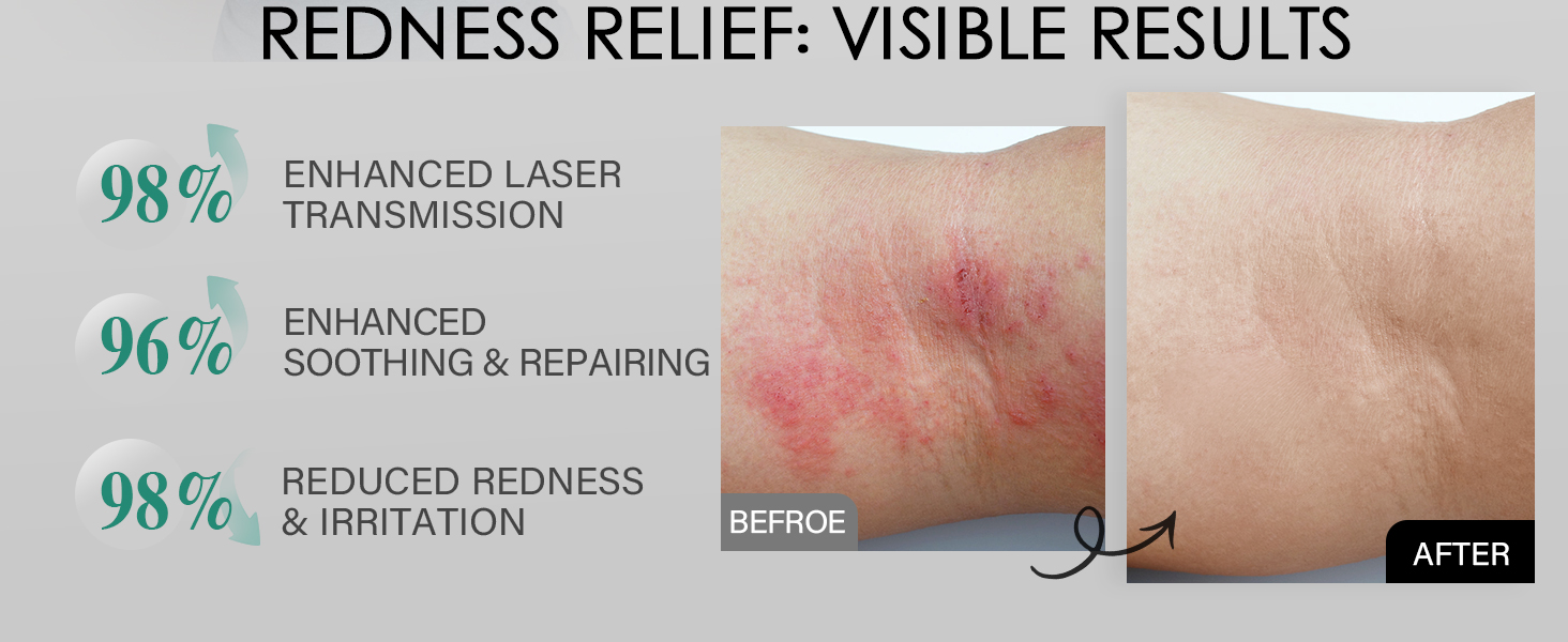 laser hair removal for women