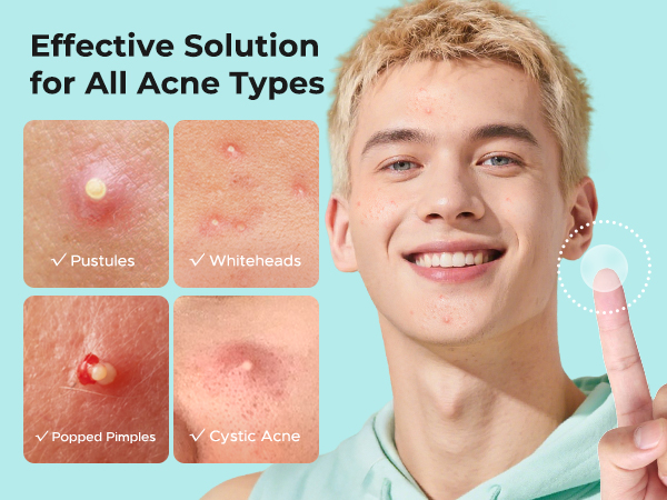 pimple patches