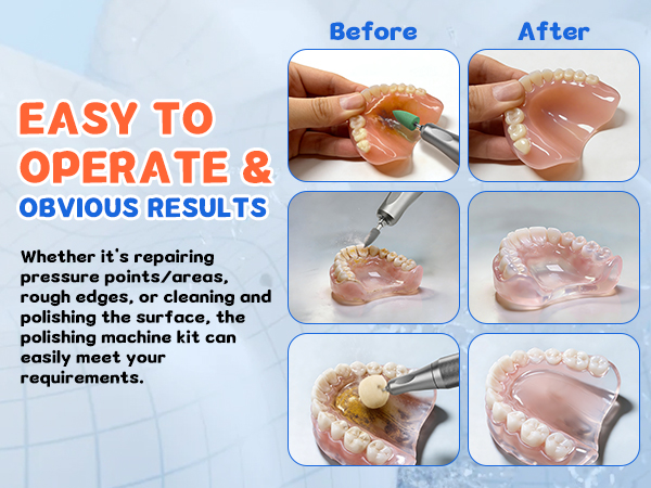 dentach repair dental dentist polisher kit denture reliner