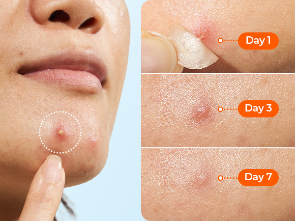 large pimple patches