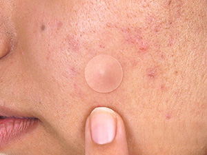 pimple patches