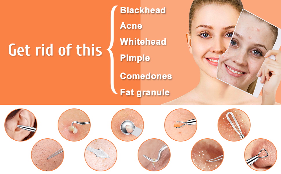 Get rid of the blackhead, acne, whitehead, pimple, comedones, fat granule