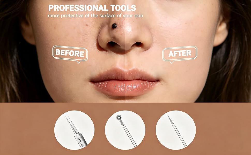 Pimple Popper Tool Kit
