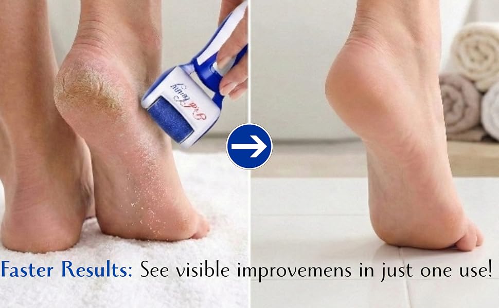 Electric Callus Remover for Feet