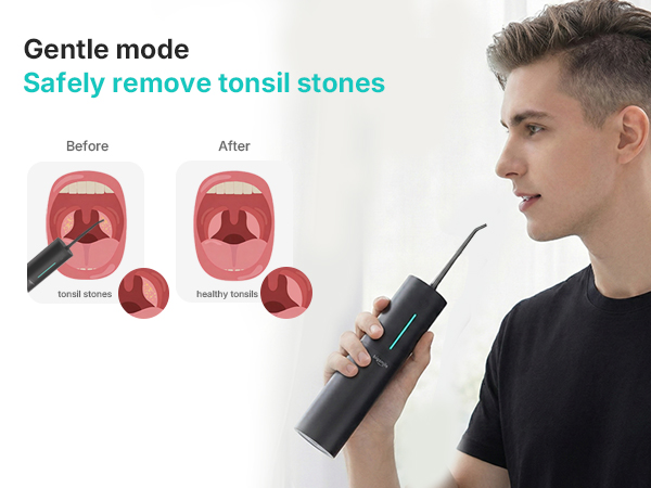 tonsil stone removal kit