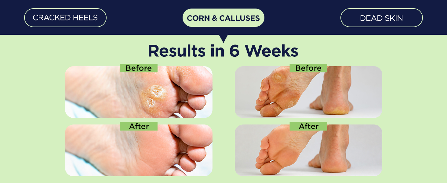 Corn & Calluses