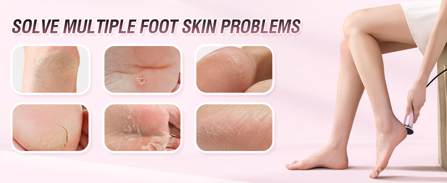 electric foot callus remover