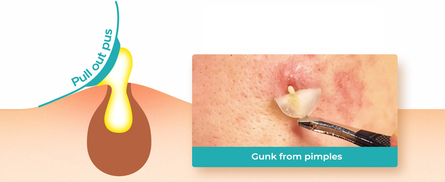 pimple patches