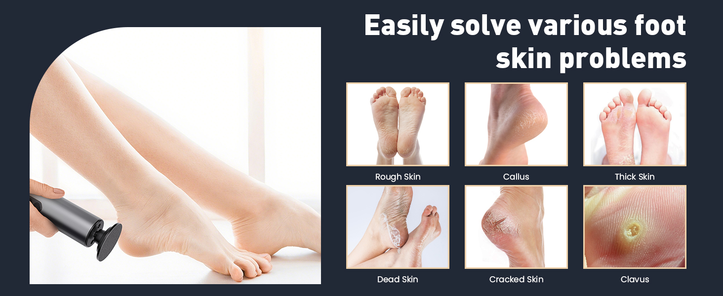 foot callus remover