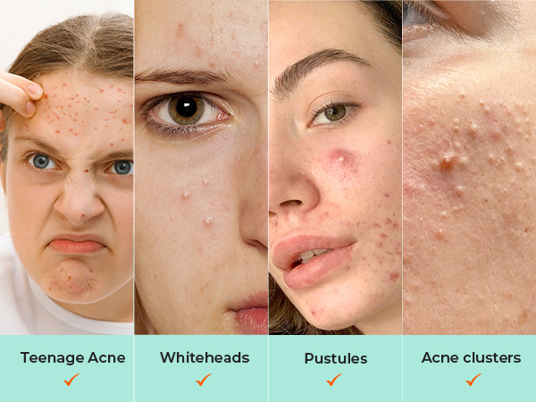 For teenage acne, whiteheads, pustules or acne clusters