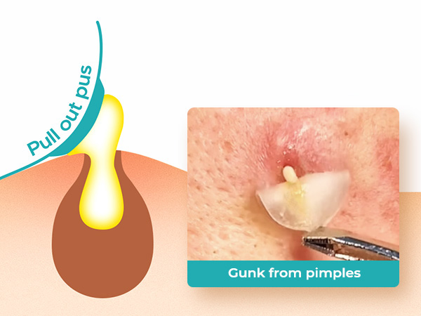 pimple patches