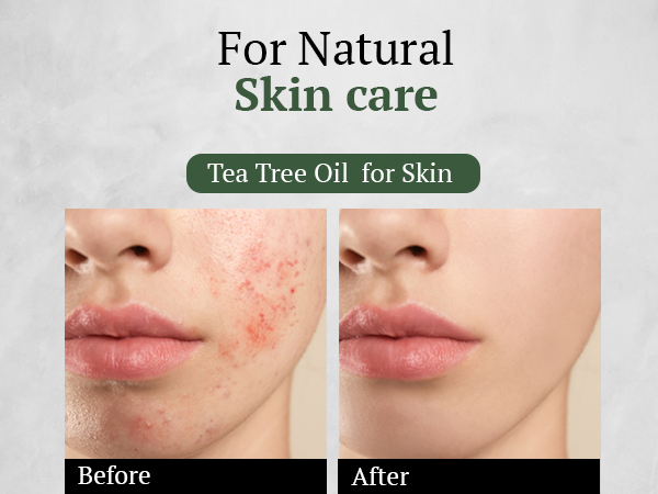 Tea Tree Oil for skin