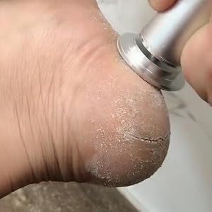 electric foot callus remover