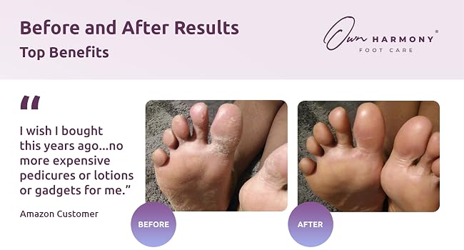 Before and after results: get smoother feet faster than pumice stone for feet, callus gel, rasp file