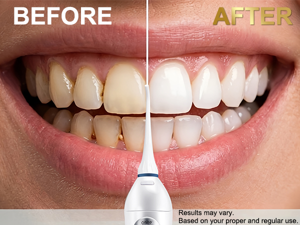 Before & After Product Effect Comparison of using the Hangsun water flosser