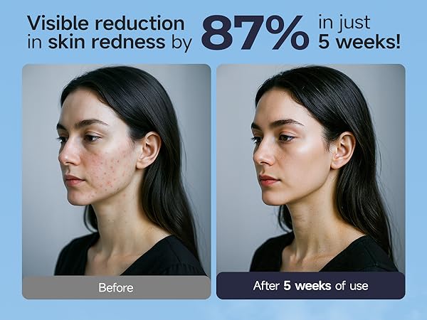 reduce redness by 87% in just 5 weeks