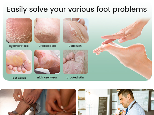 foot callus remover pedicure foot spa foot care feet scrubber dead skin foot scrub heel scraper foot